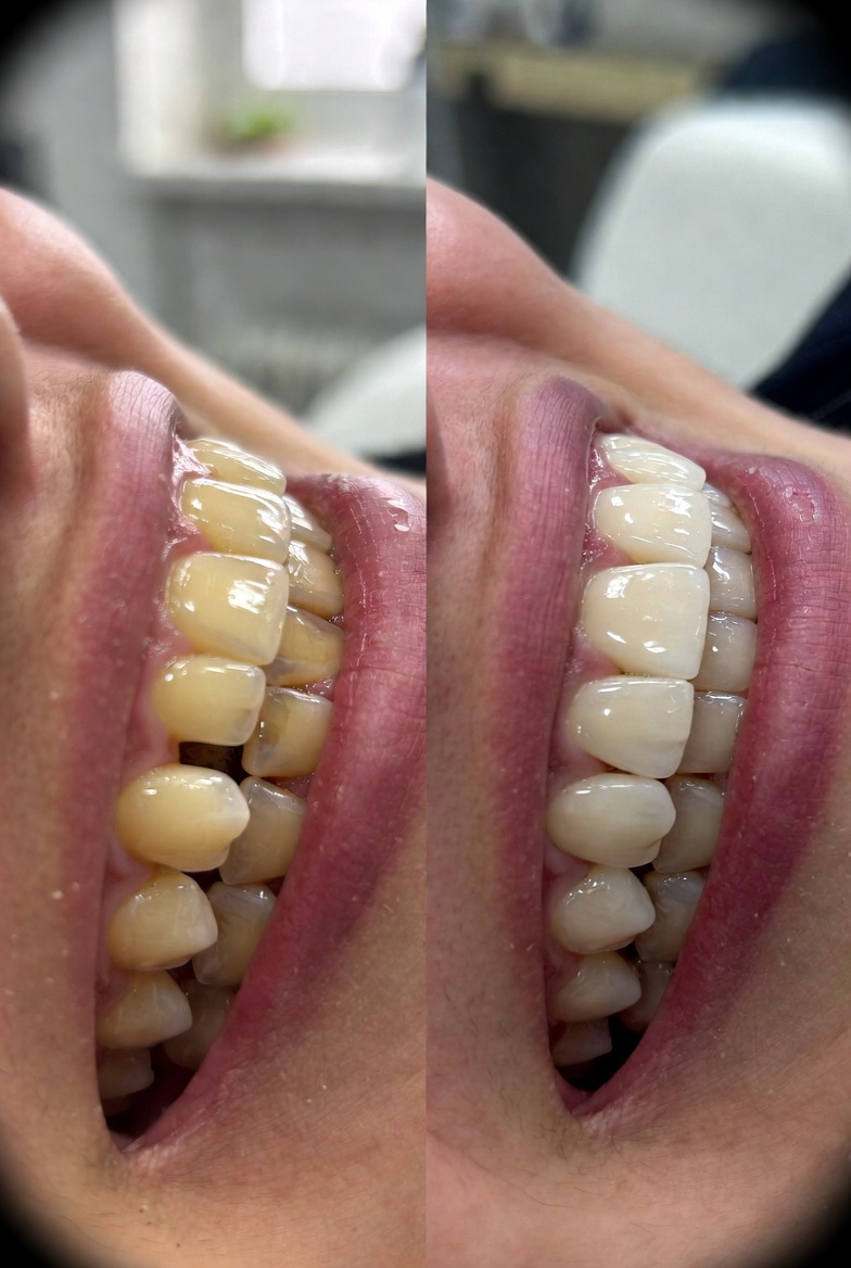 라미네이트전후