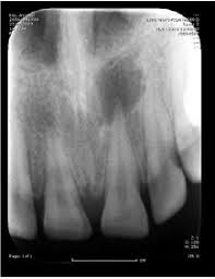 치근단염 예시 이미지