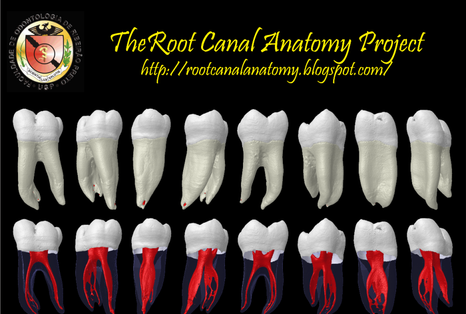 복잡한 근관 형태