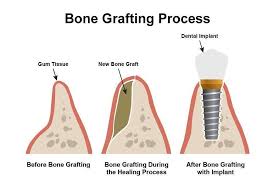 치조골 이식 수술 과정