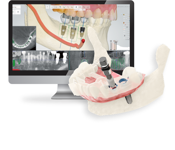 3D 네비게이션 임플란트 개념