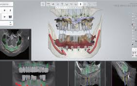 임플란트 CT 분석