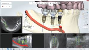 디지털 임플란트 계획