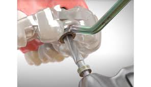 가이드 임플란트 수술