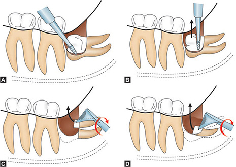 사랑니 발치 과정