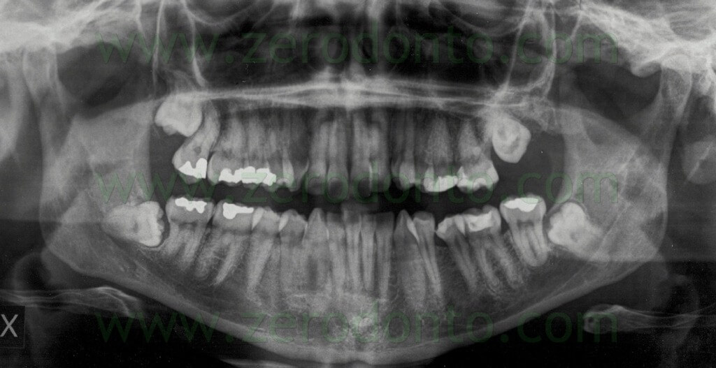 사랑니 파노라마 엑스레이