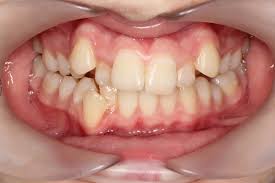 덧니 및 부정교합 사례