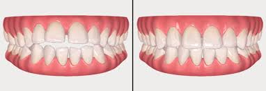 투명교정 시뮬레이션