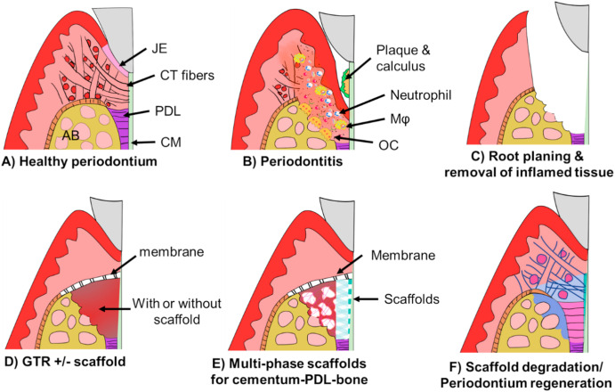 치주조직 재건 개념