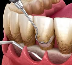 적극적 치주치료