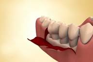 치주 판막 수술