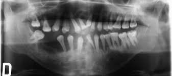 진행된 치주염 예시 이미지