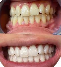 치아 미백 전후