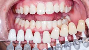 치아 색상 비교