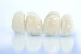 올세라믹 크라운