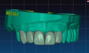라미네이트 최소 삭제
