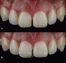 라미네이트 전후